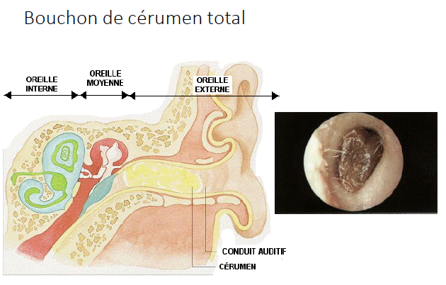 Bouchons de cérumen - Karine Ouellet-L'important du nettoyage d'oreilles